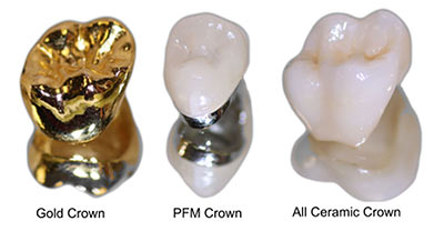 Dental Crowns treatment at Magic Dental