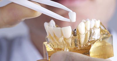 invisalign treatment at Magic Dental